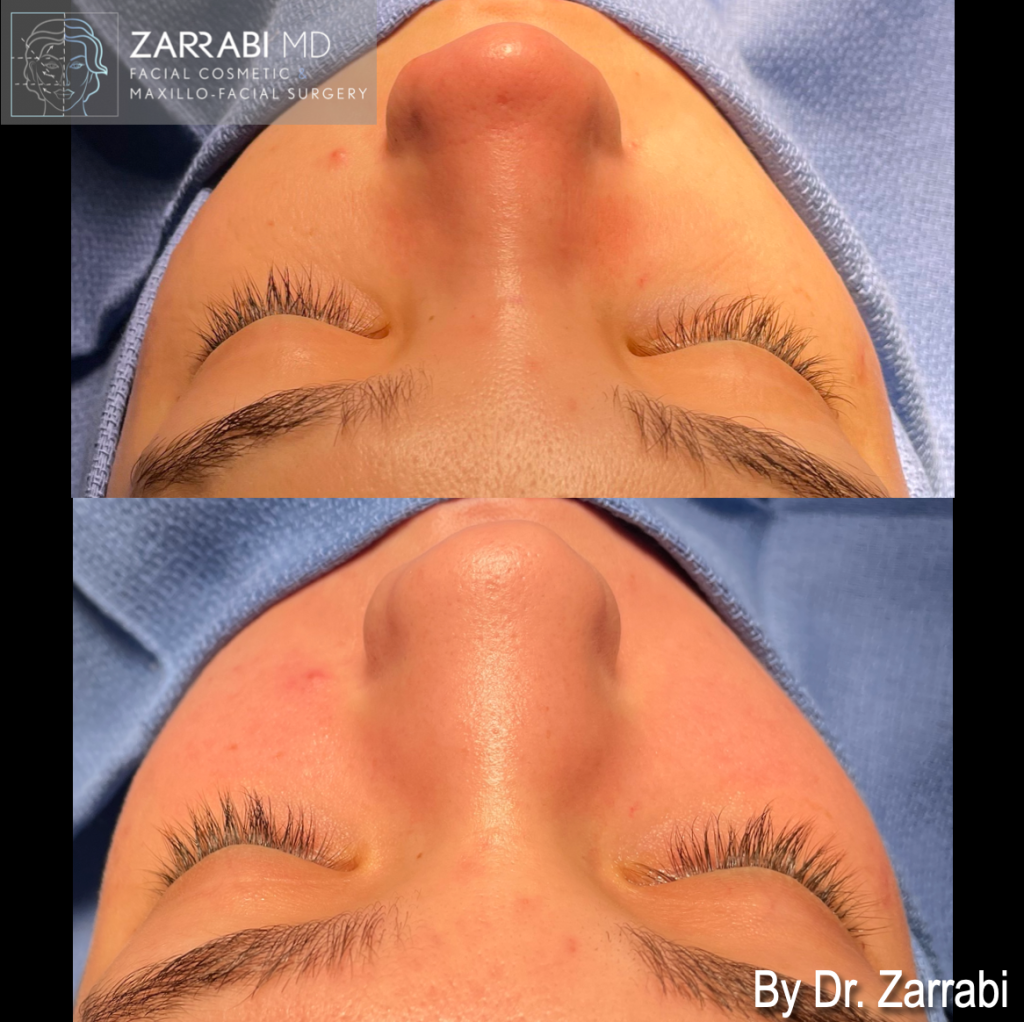 Closed Piezo Rhinoplasty 1 10