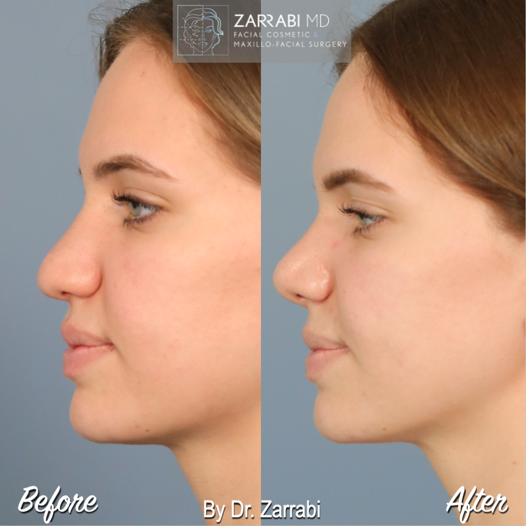 Closed Piezo Rhinoplasty 1 11