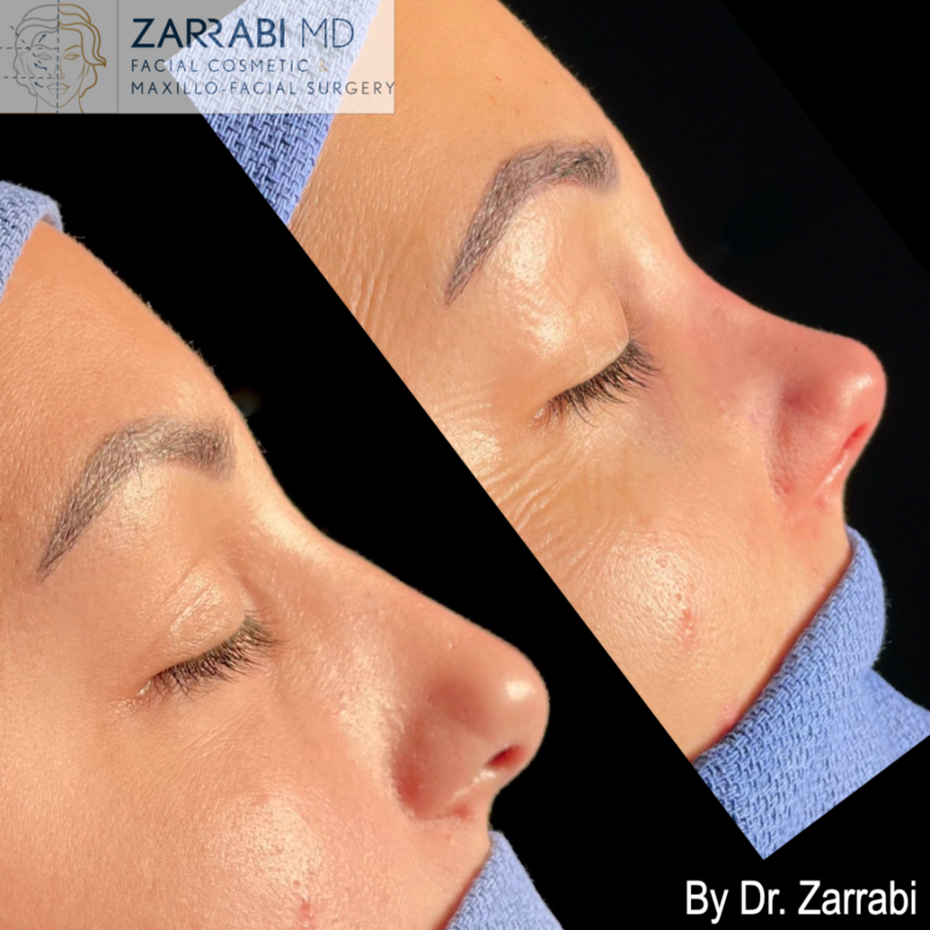 Closed Piezo Rhinoplasty 1 14