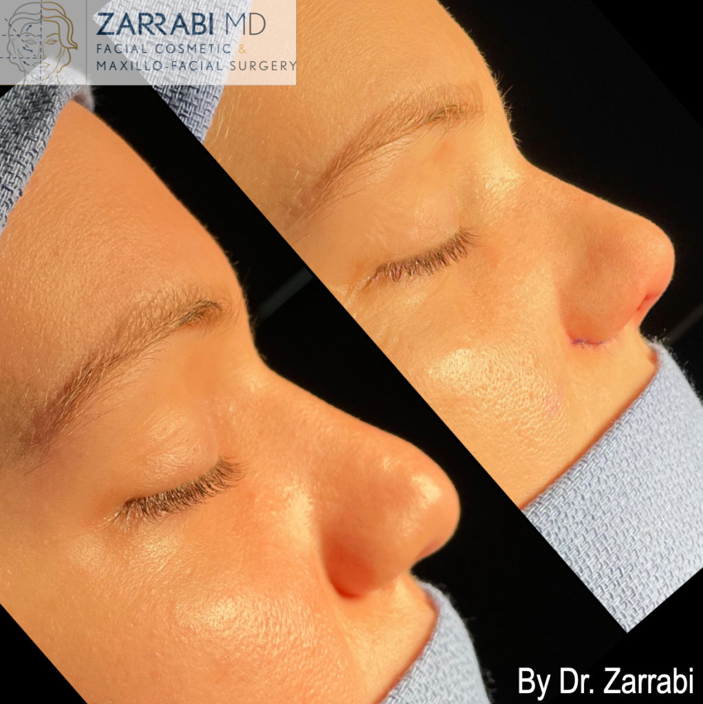 Closed Piezo Rhinoplasty 1 16