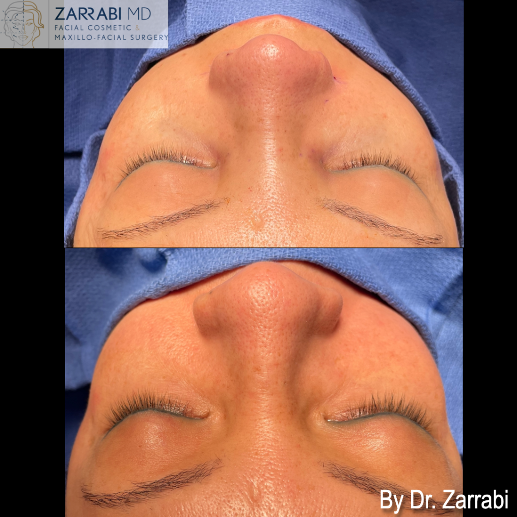 Closed Piezo Rhinoplasty 1 17