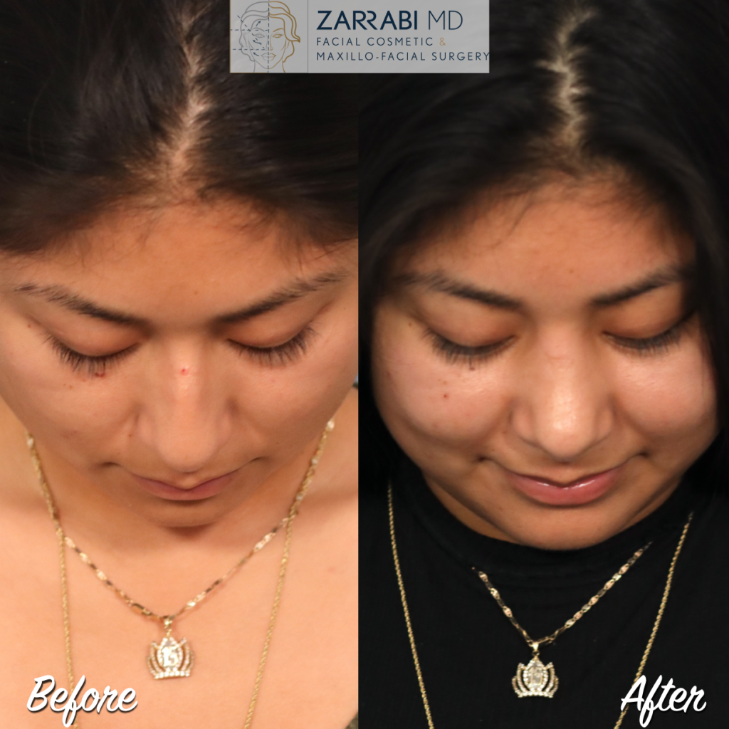 Closed Piezo Rhinoplasty 1 18