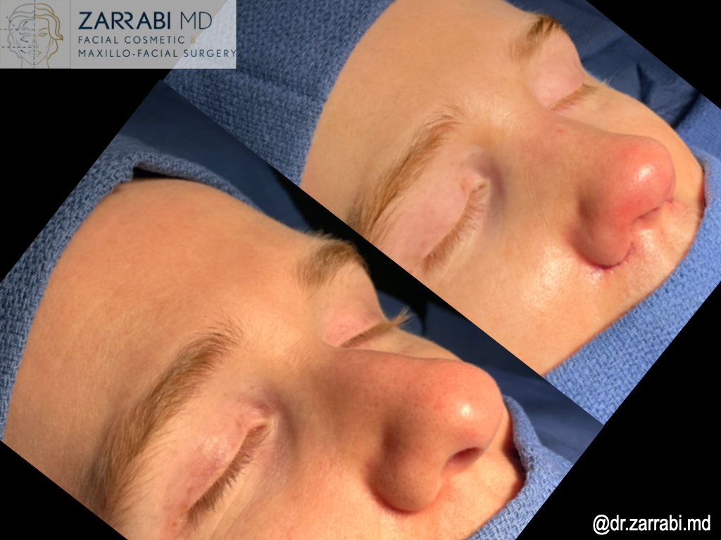 Closed Piezo Rhinoplasty 1 19