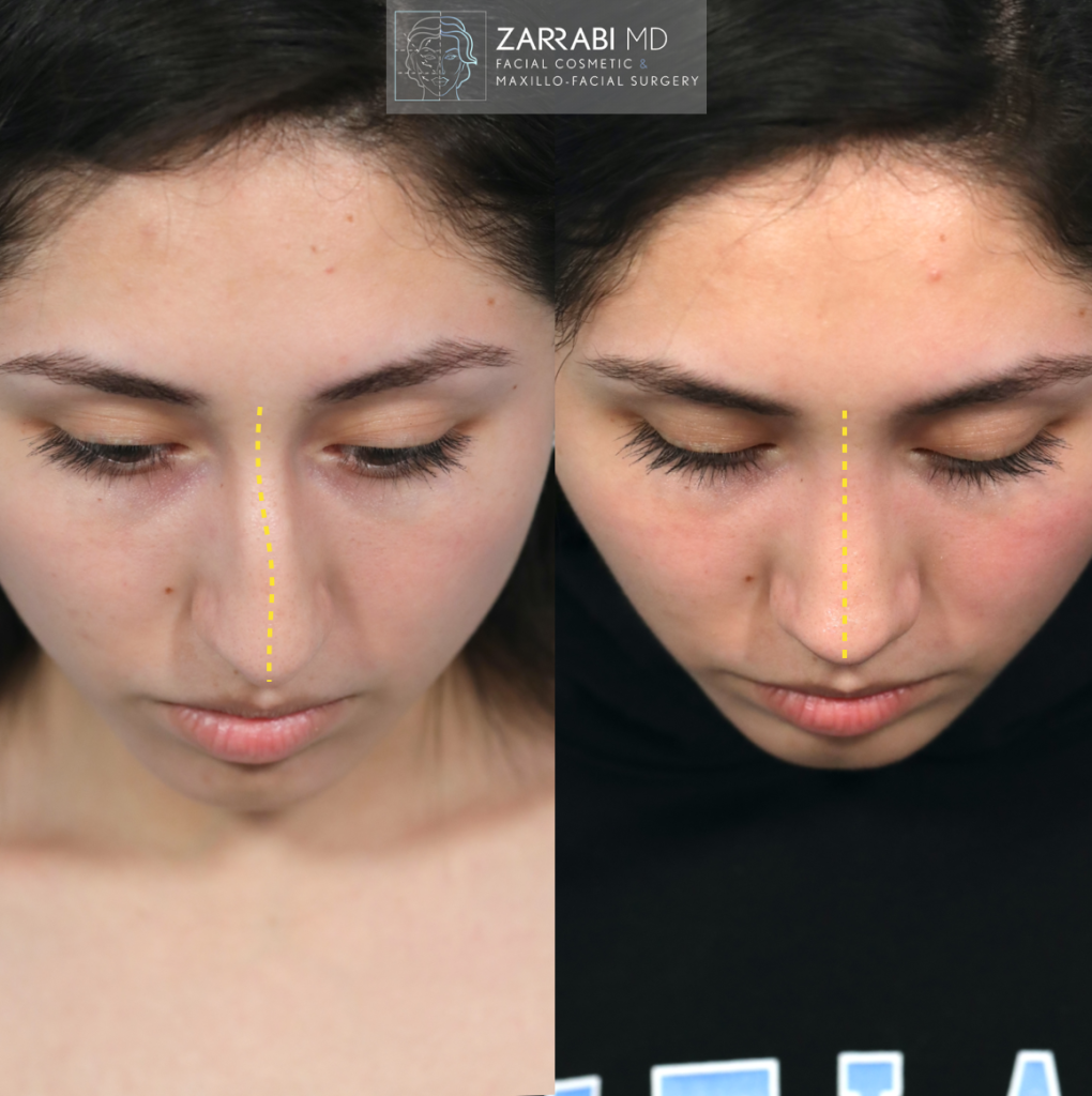 Closed Piezo Rhinoplasty 1 2