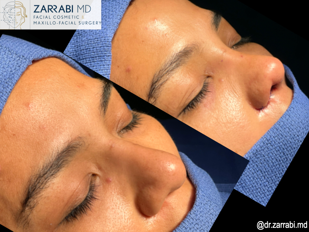 Closed Piezo Rhinoplasty 1 20