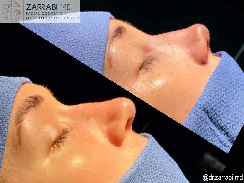 Closed Piezo Rhinoplasty 1 22