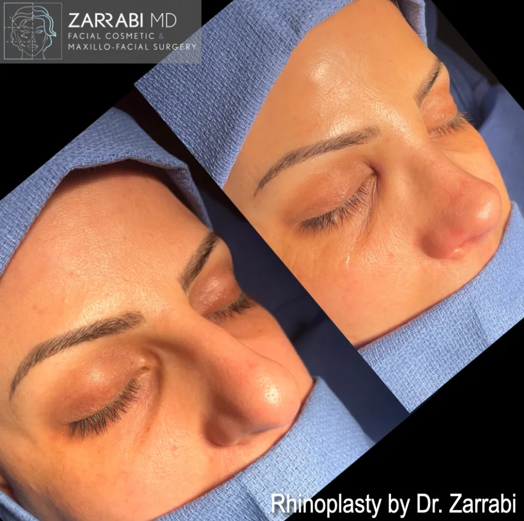 Closed Piezo Rhinoplasty 1 4