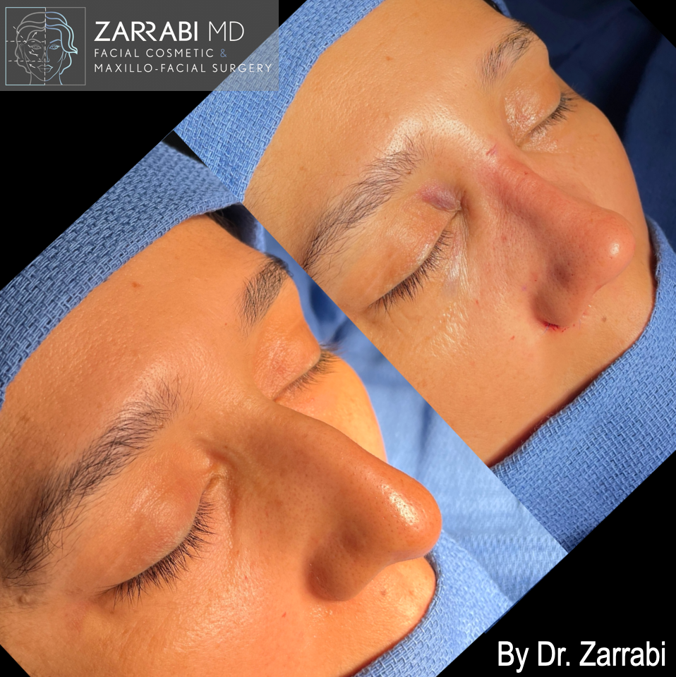 Closed Piezo Rhinoplasty 1 5