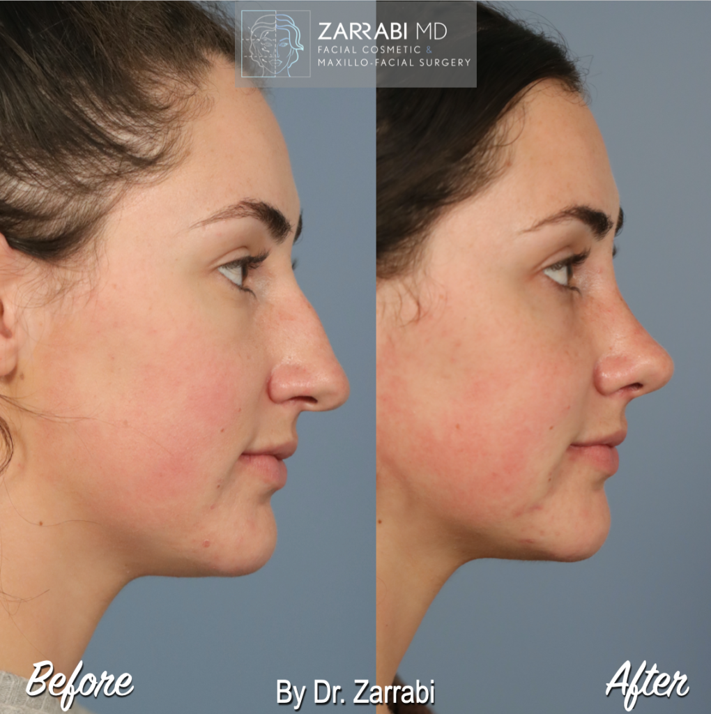 Closed Piezo Rhinoplasty 1 6