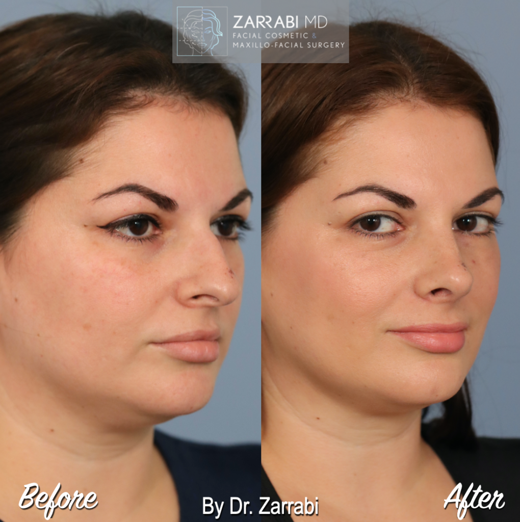 Closed Piezo Rhinoplasty 1 7