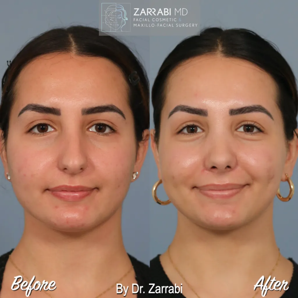 Closed Piezo Rhinoplasty 1 8