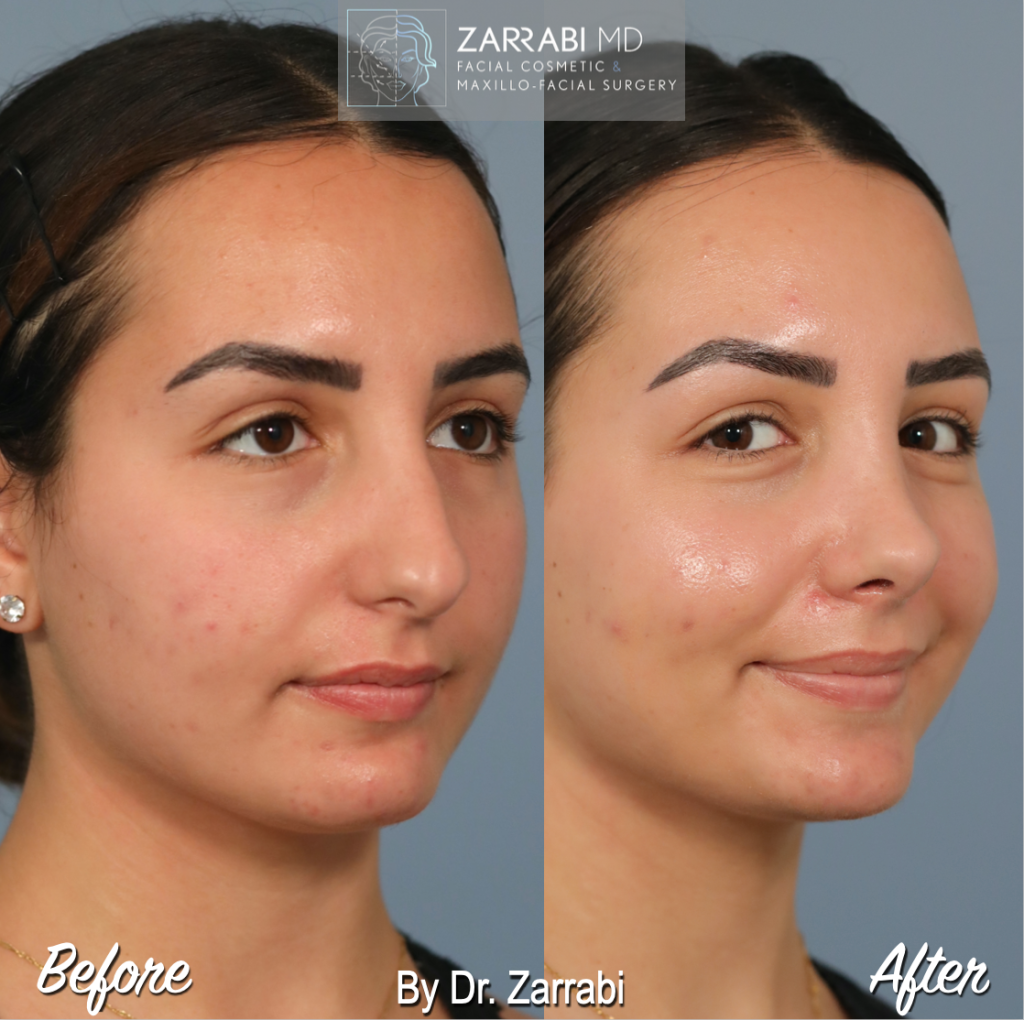 Closed Piezo Rhinoplasty 1 9