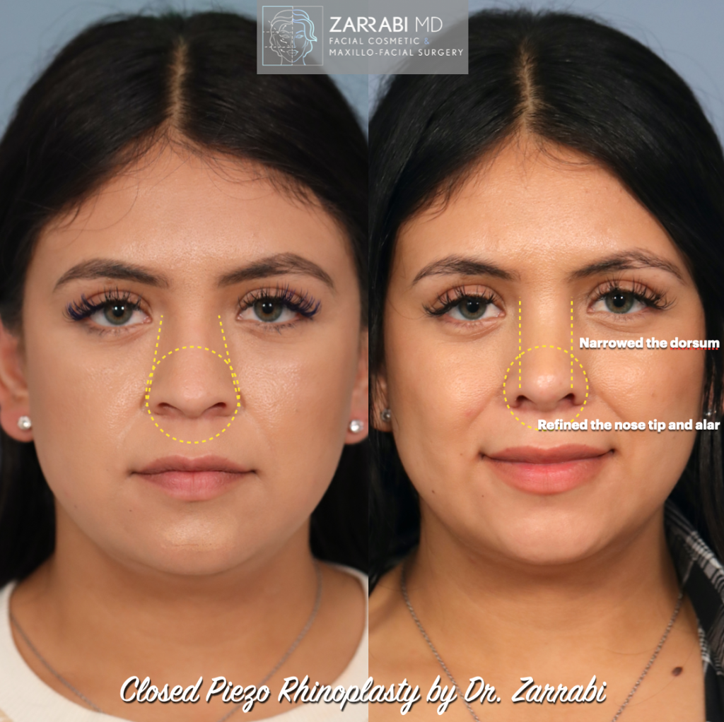 Closed Piezo Rhinoplasty 2 1