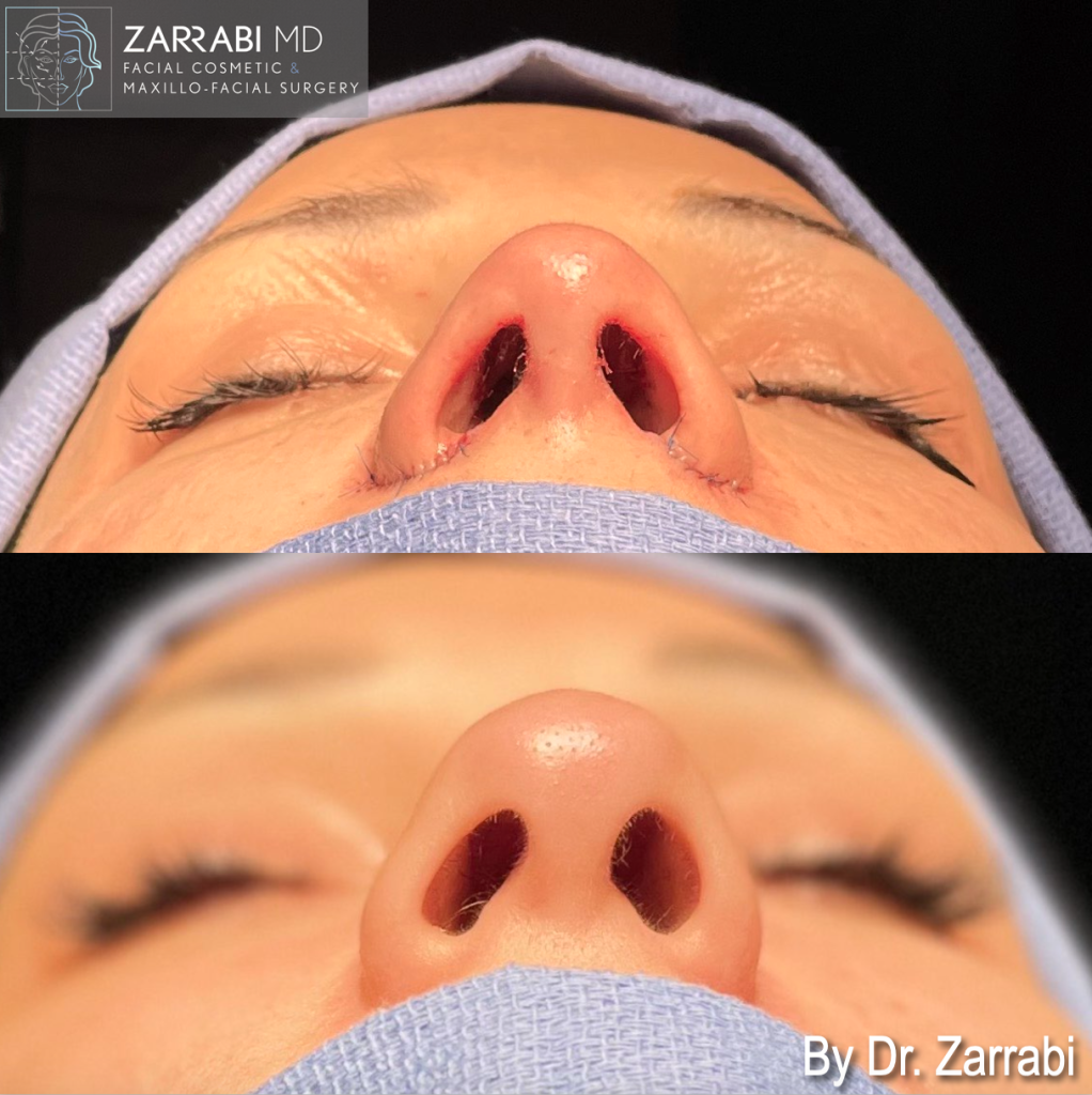 Closed Piezo Rhinoplasty 2 11