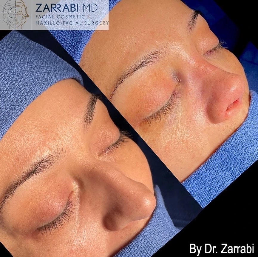 Closed Piezo Rhinoplasty 2 12