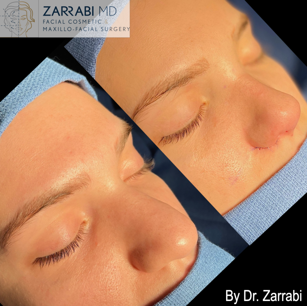 Closed Piezo Rhinoplasty 2 14