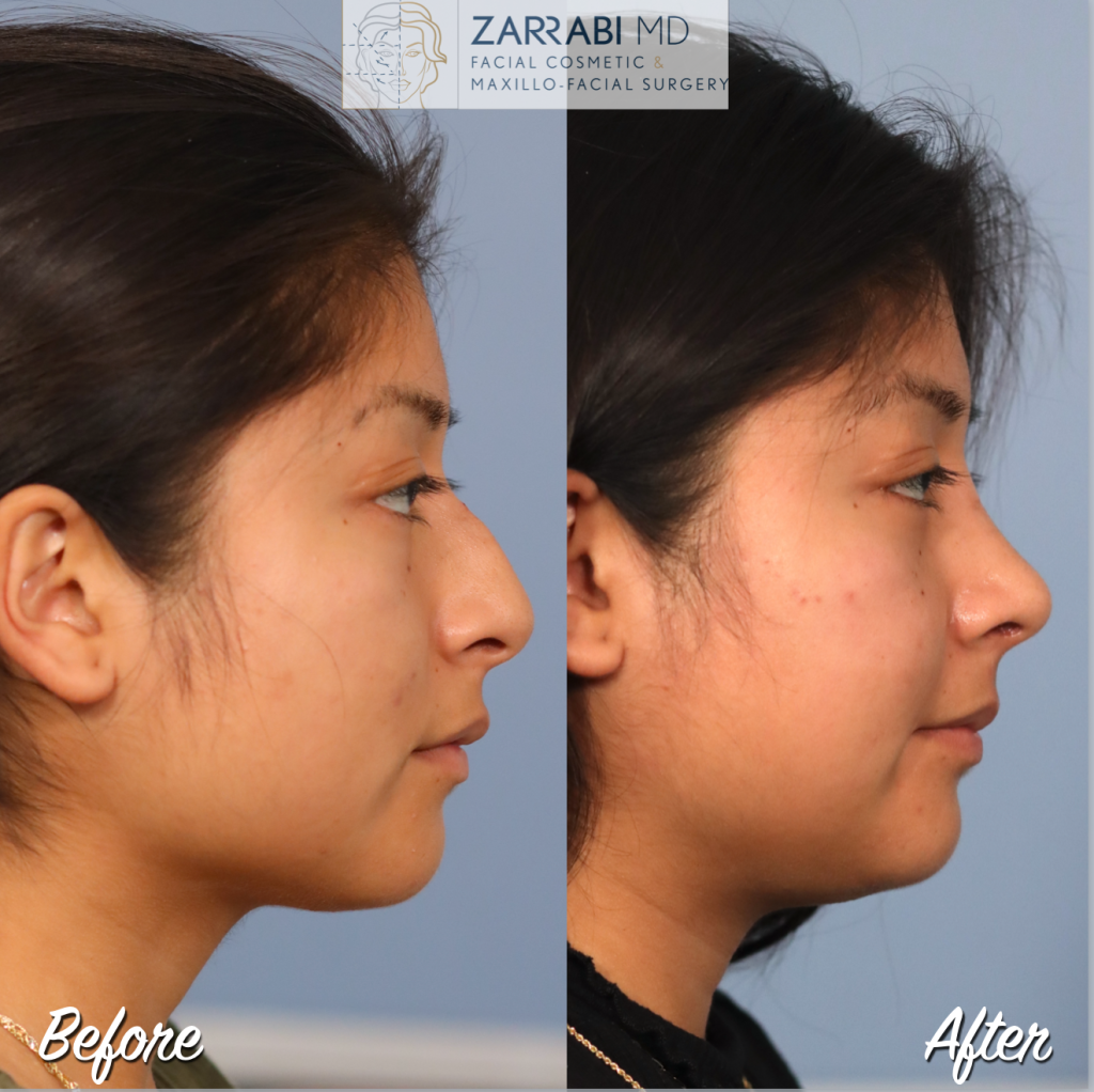 Closed Piezo Rhinoplasty 2 16