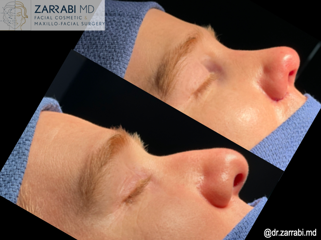 Closed Piezo Rhinoplasty 2 17