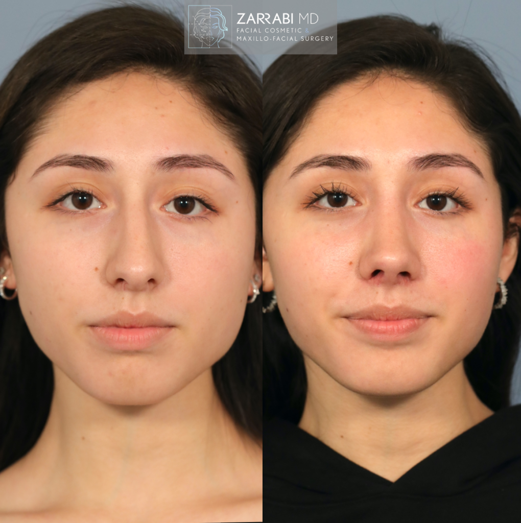 Closed Piezo Rhinoplasty 2 2