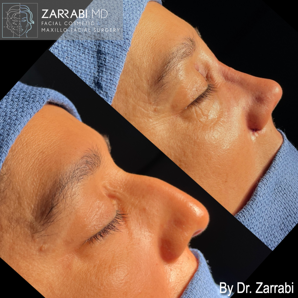 Closed Piezo Rhinoplasty 2 5