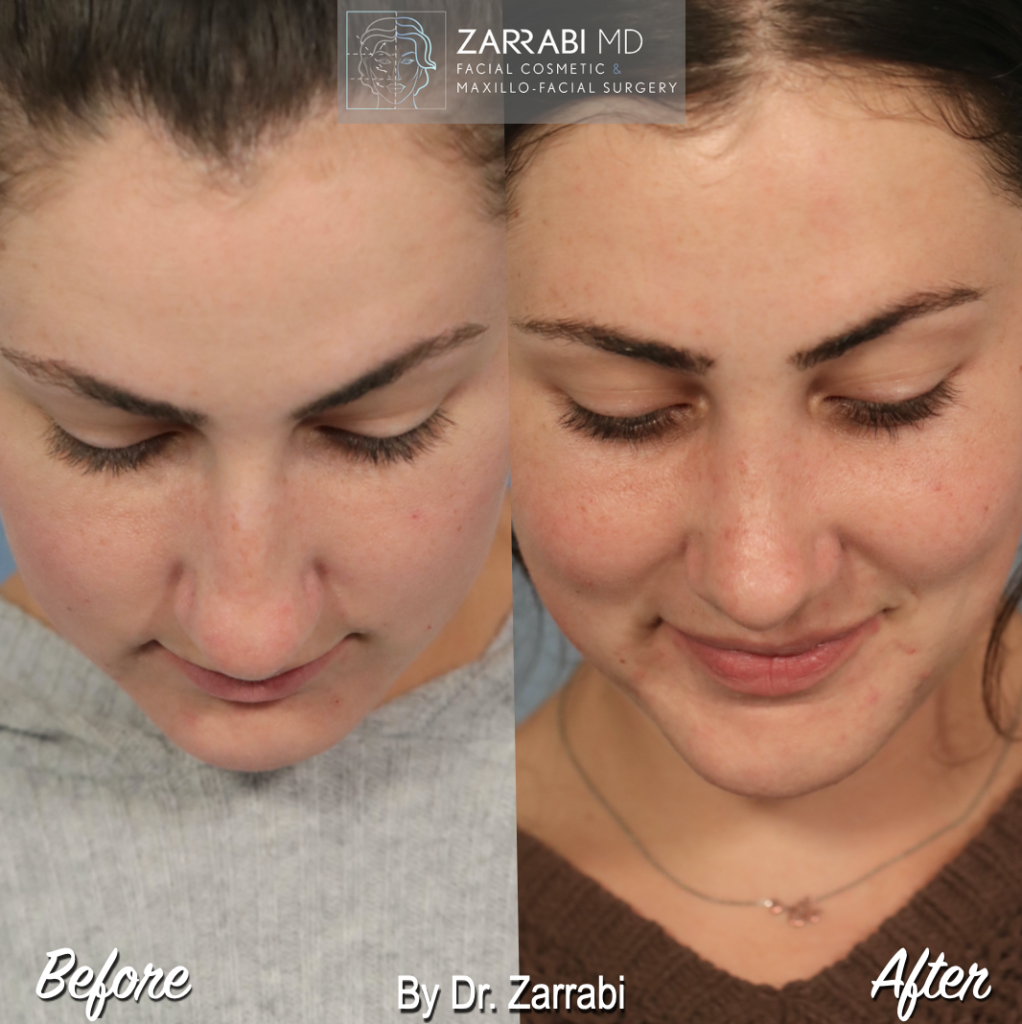 Closed Piezo Rhinoplasty 2 6