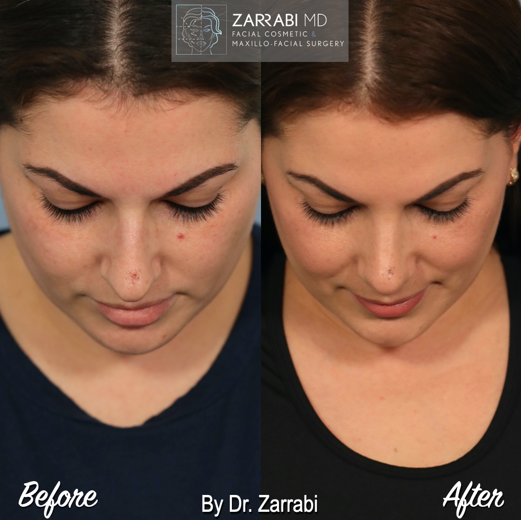 Closed Piezo Rhinoplasty 2 7