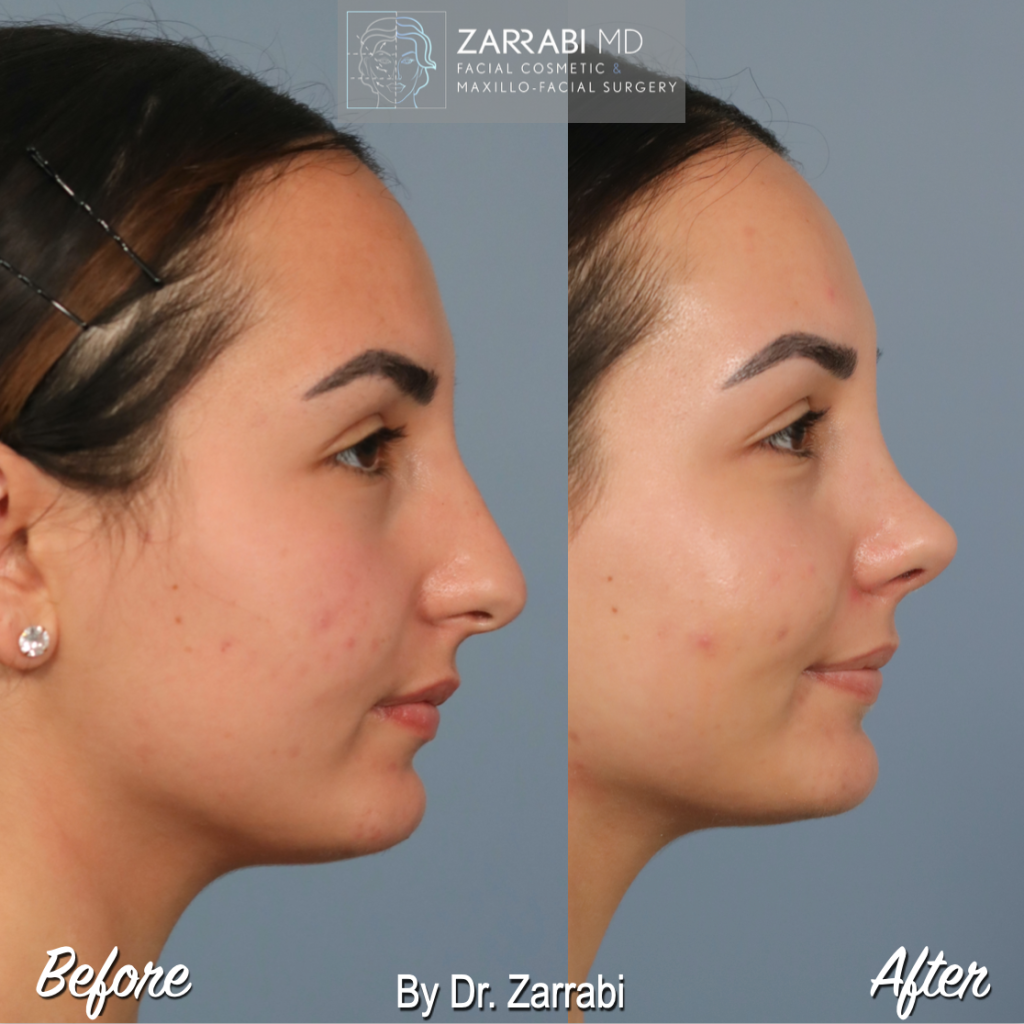 Closed Piezo Rhinoplasty 2 8