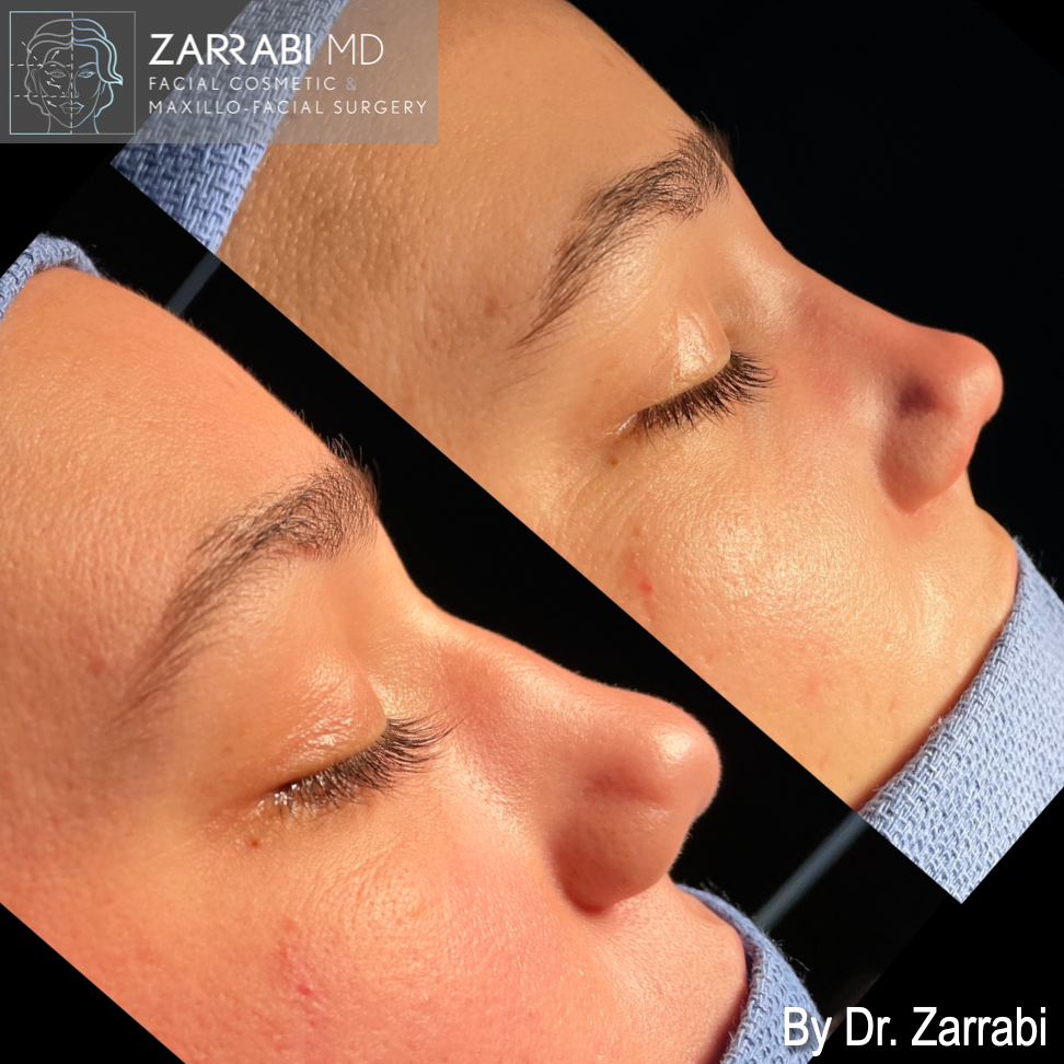 Closed Piezo Rhinoplasty 2 9