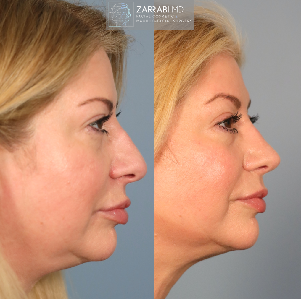 Closed Piezo Rhinoplasty 2