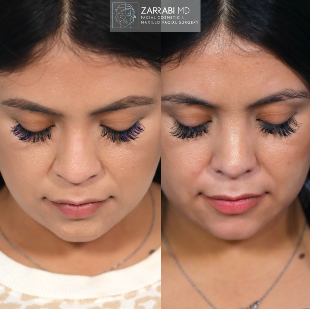 Closed Piezo Rhinoplasty 3 1