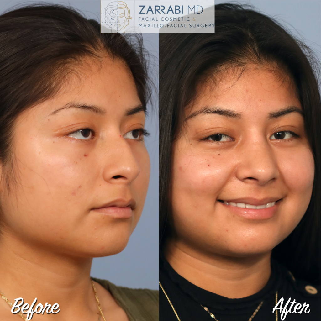 Closed Piezo Rhinoplasty 3 12