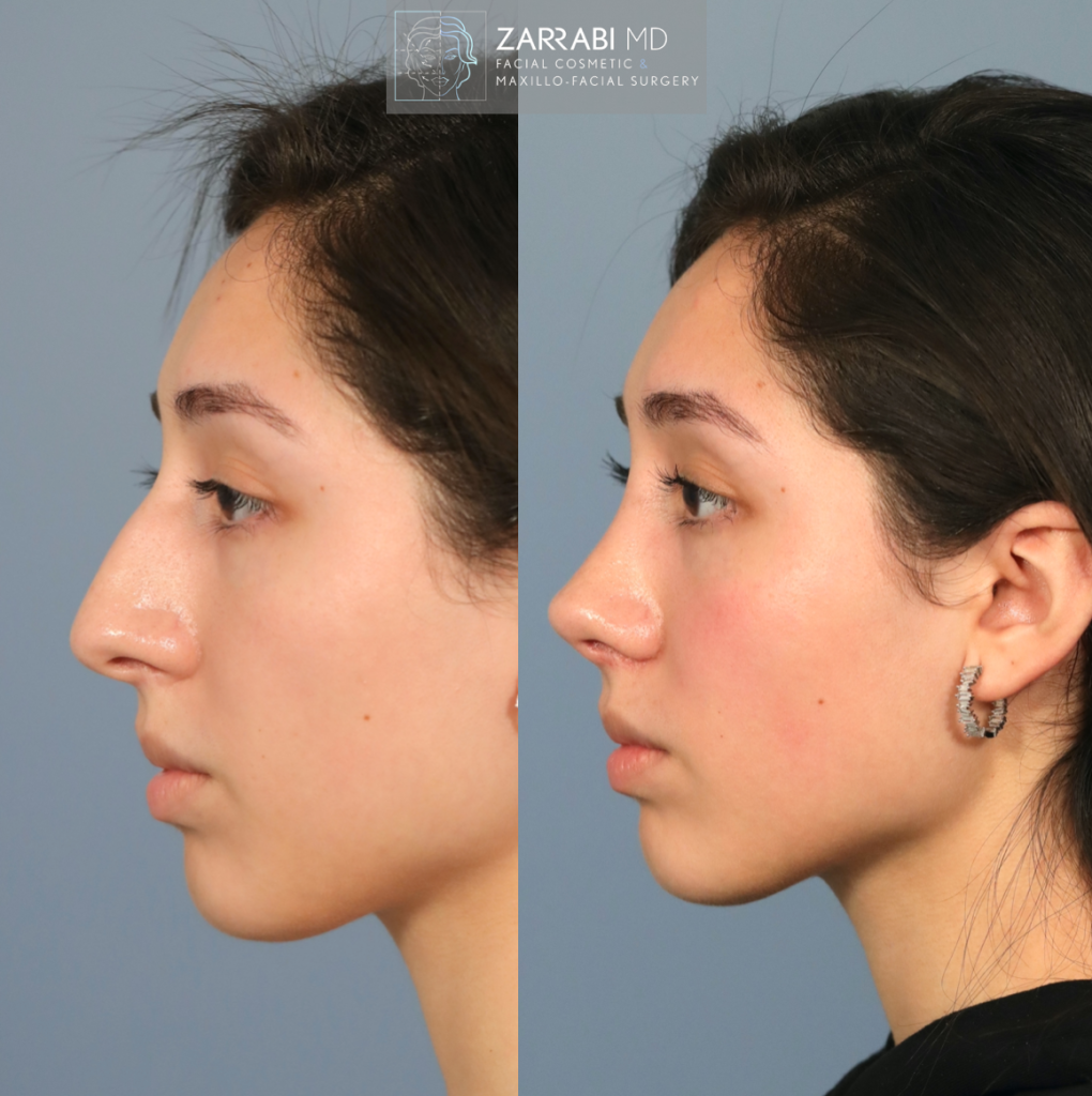 Closed Piezo Rhinoplasty 3 2