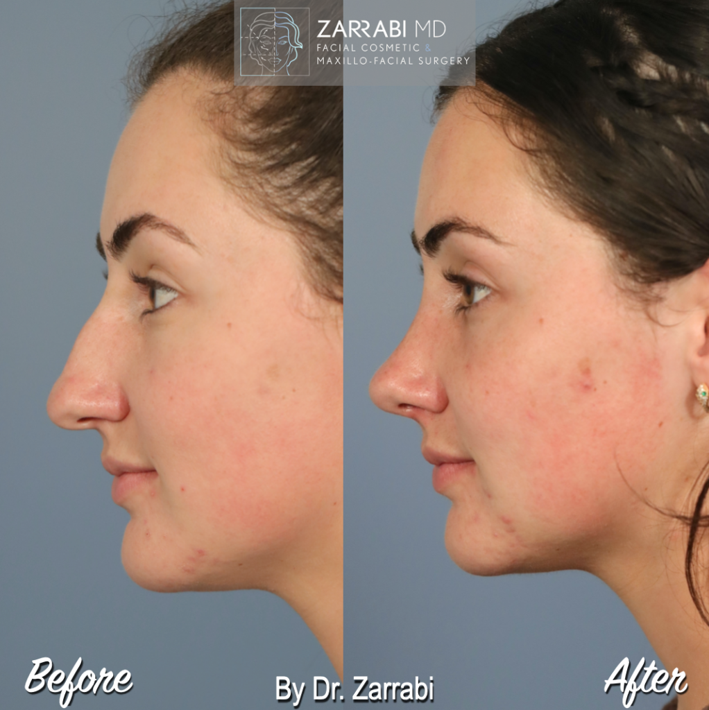 Closed Piezo Rhinoplasty 3 5