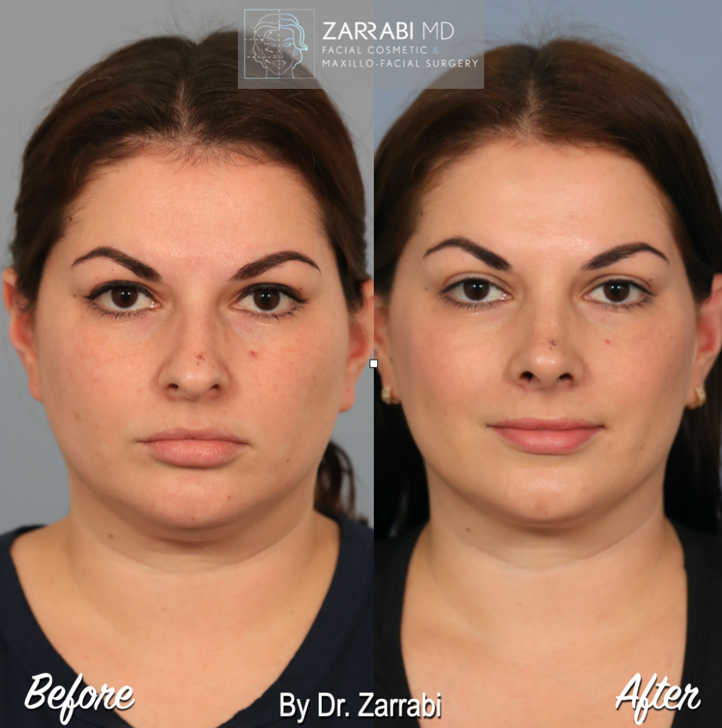 Closed Piezo Rhinoplasty 3 6