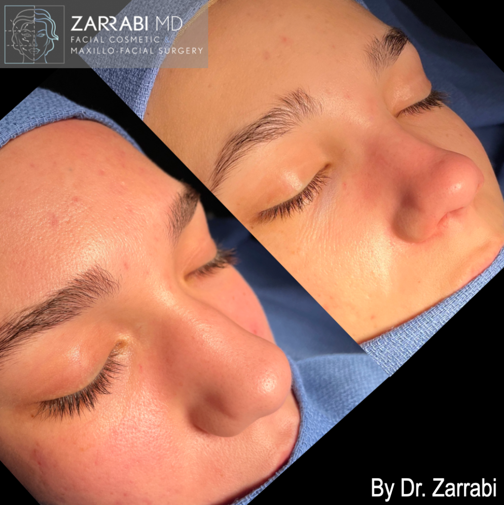 Closed Piezo Rhinoplasty 3 8