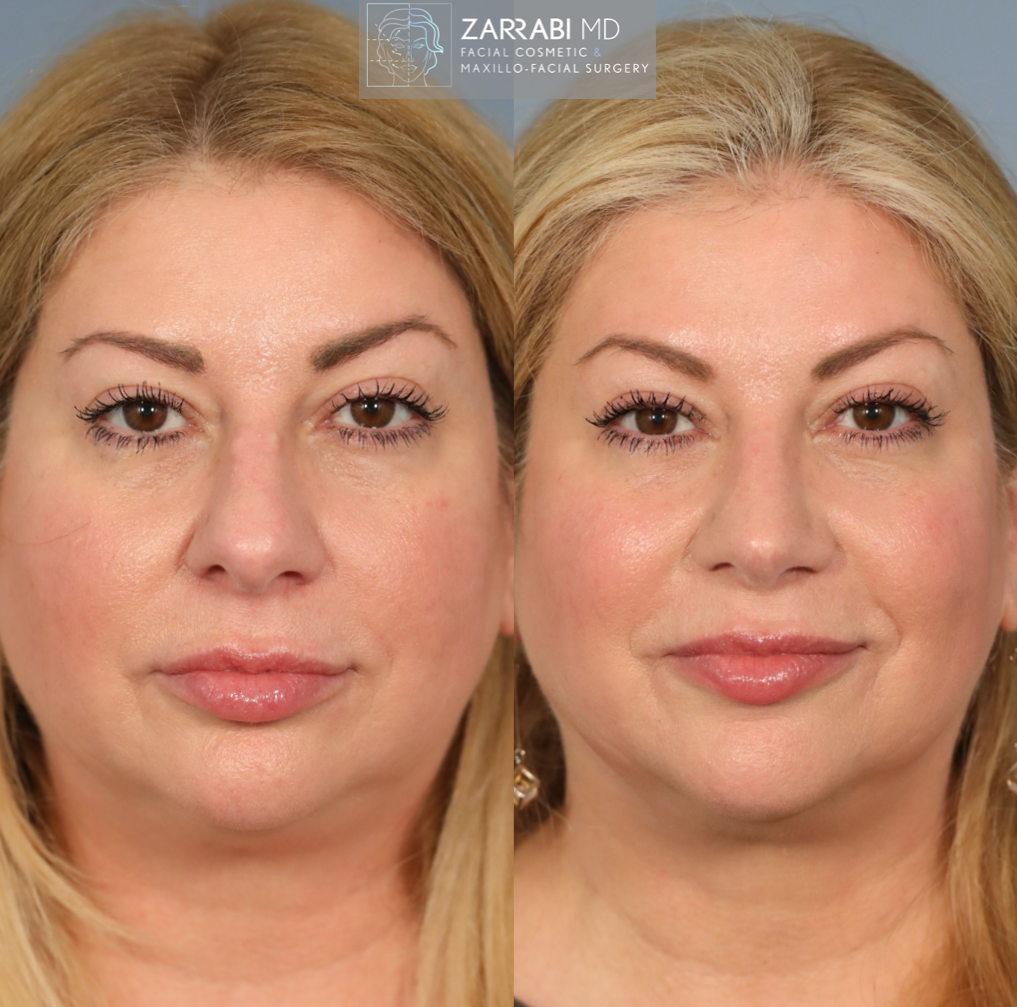 Closed Piezo Rhinoplasty 3