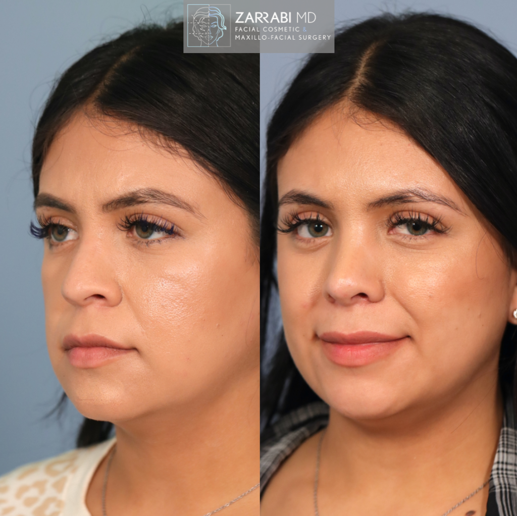 Closed Piezo Rhinoplasty 4 1