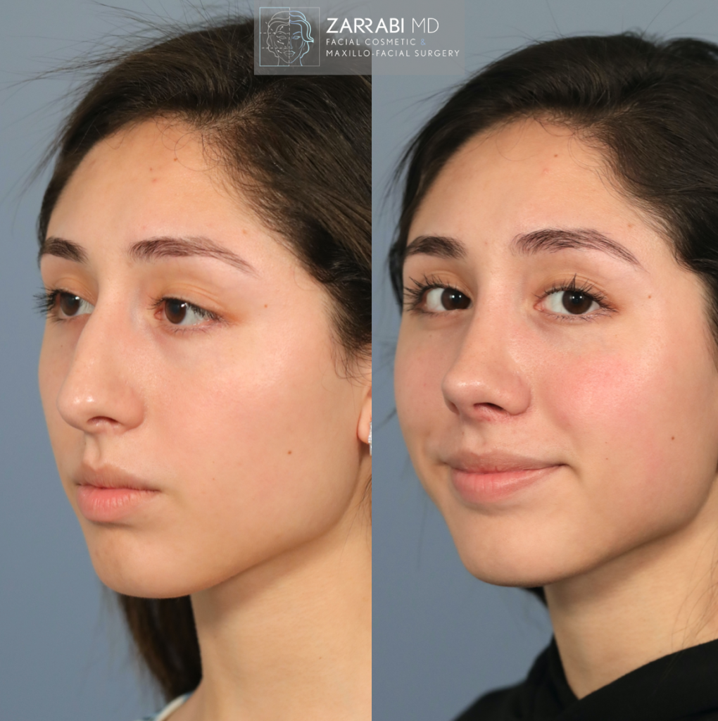 Closed Piezo Rhinoplasty 4 2