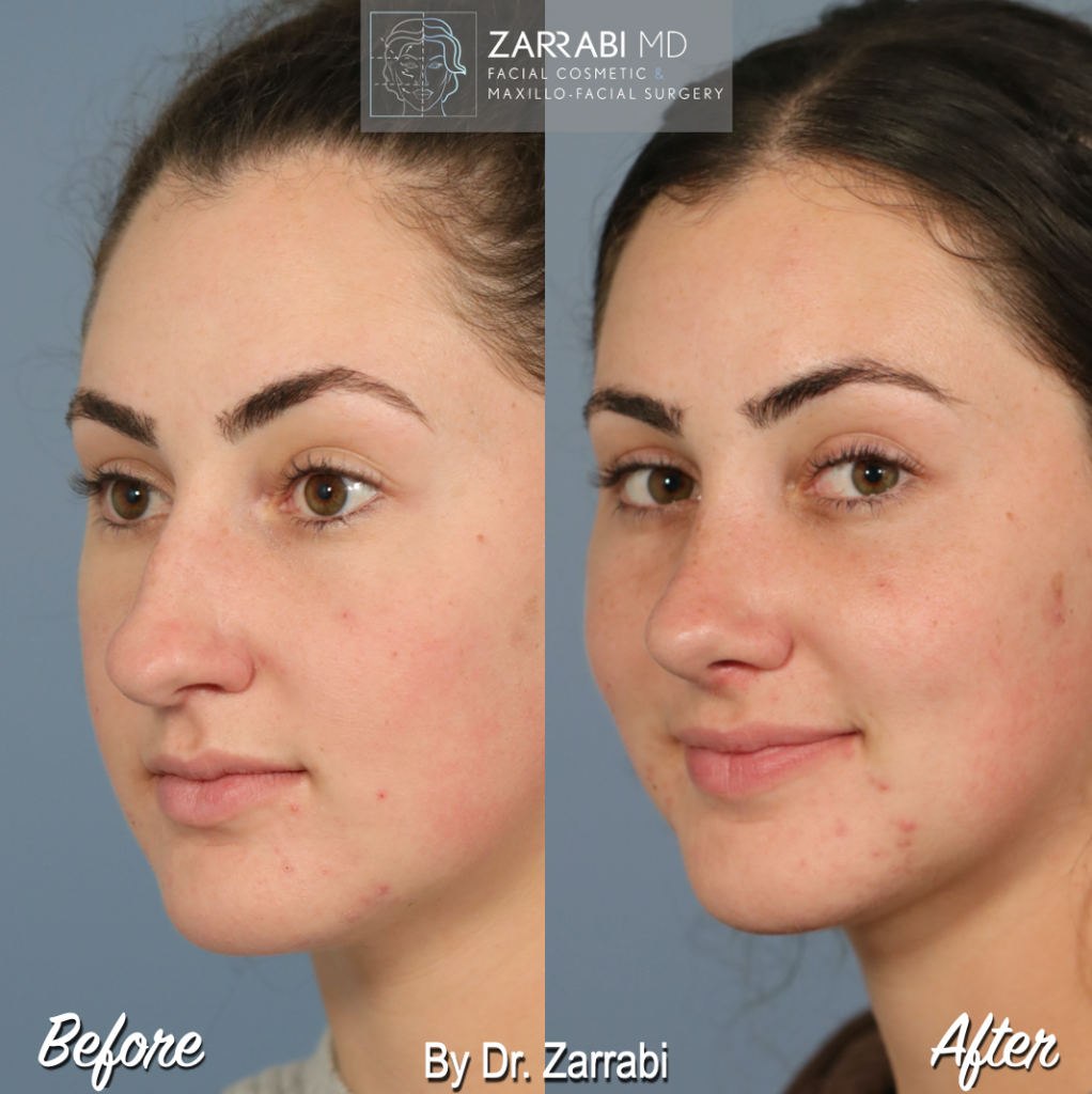 Closed Piezo Rhinoplasty 4 4