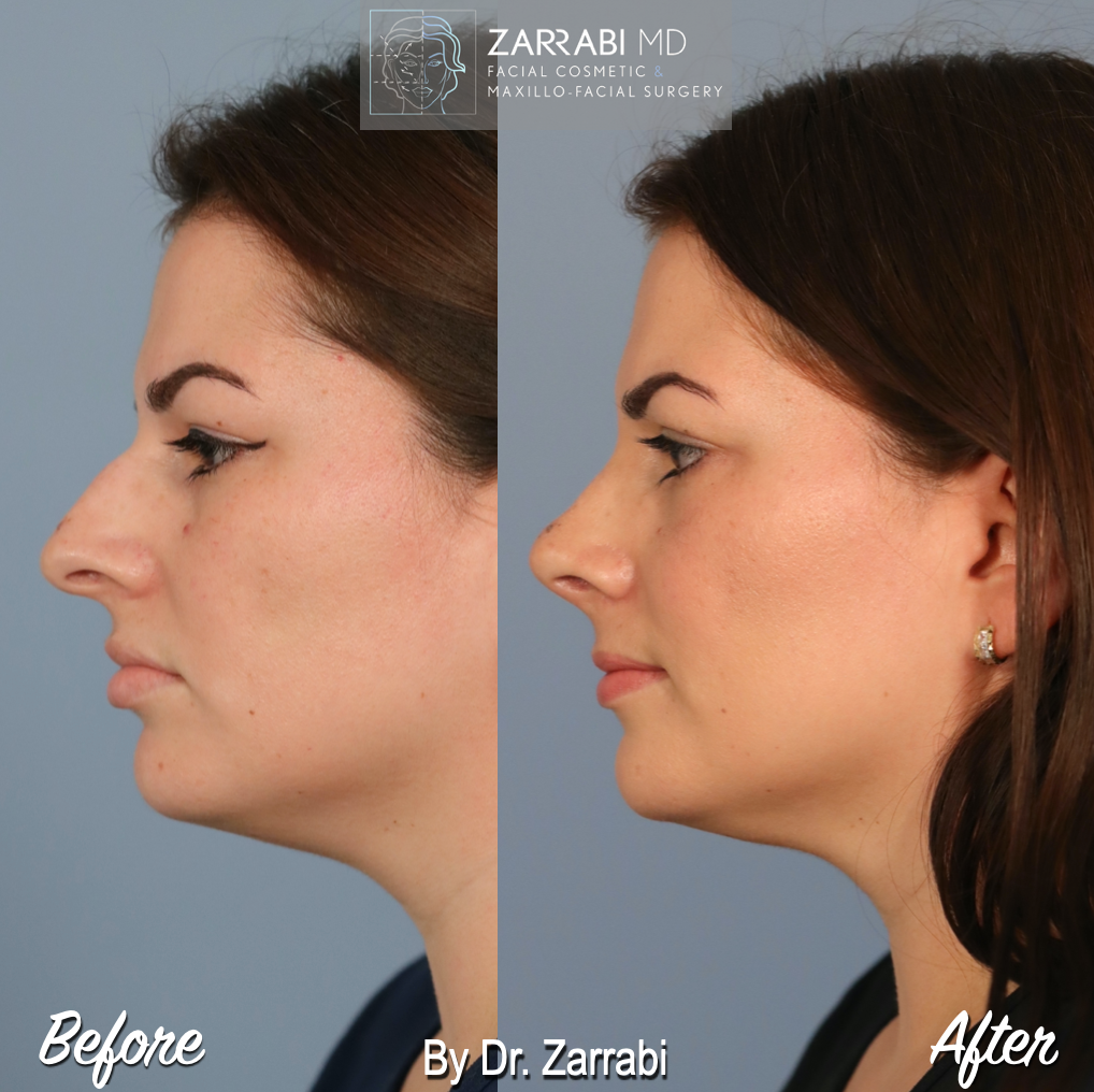 Closed Piezo Rhinoplasty 4 5