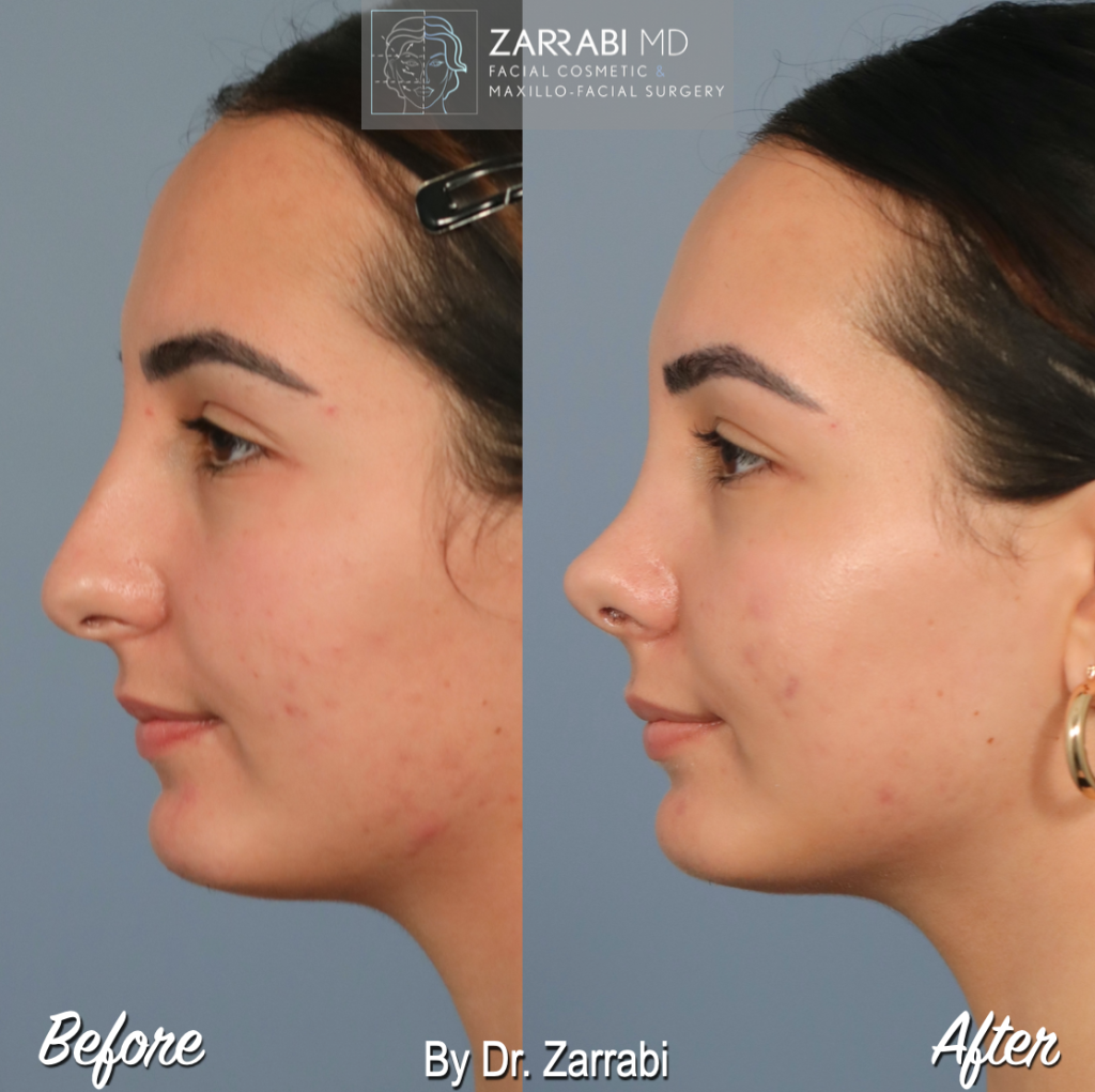 Closed Piezo Rhinoplasty 4 6