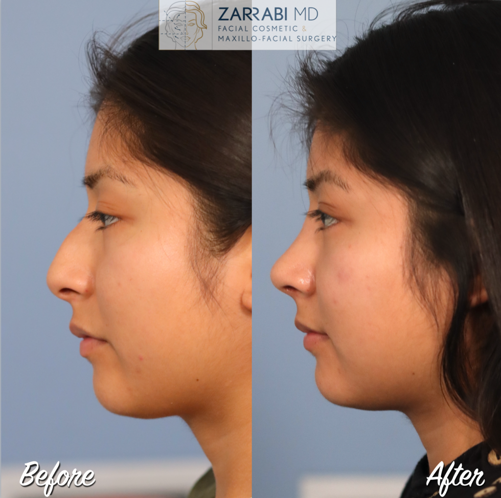 Closed Piezo Rhinoplasty 4 9