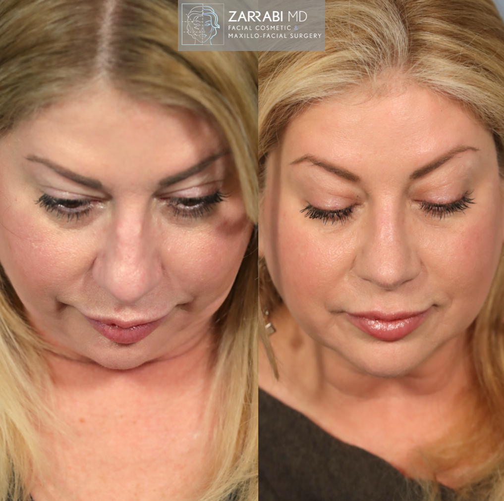 Closed Piezo Rhinoplasty 4