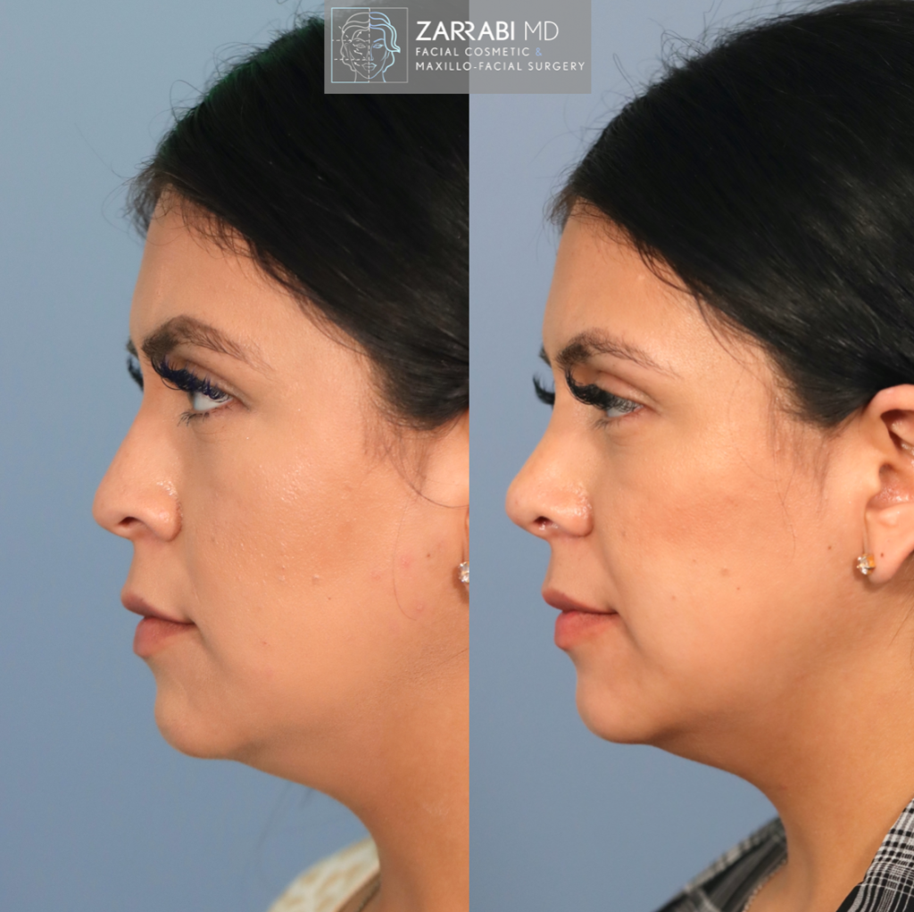 Closed Piezo Rhinoplasty 5 1