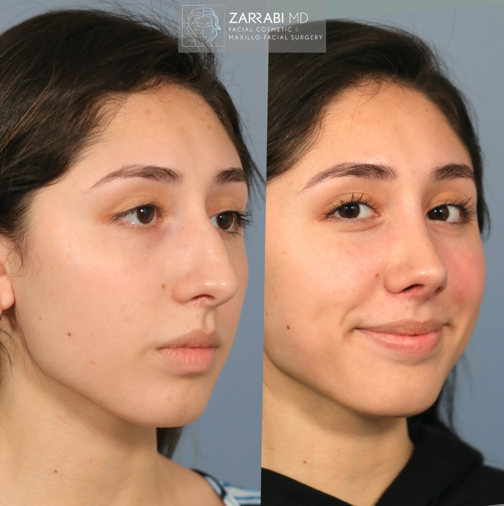 Closed Piezo Rhinoplasty 5 2