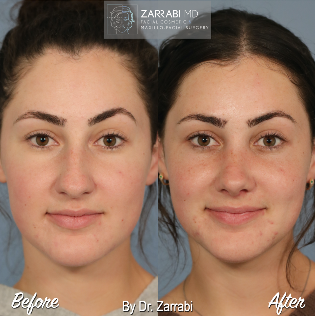 Closed Piezo Rhinoplasty 5 4