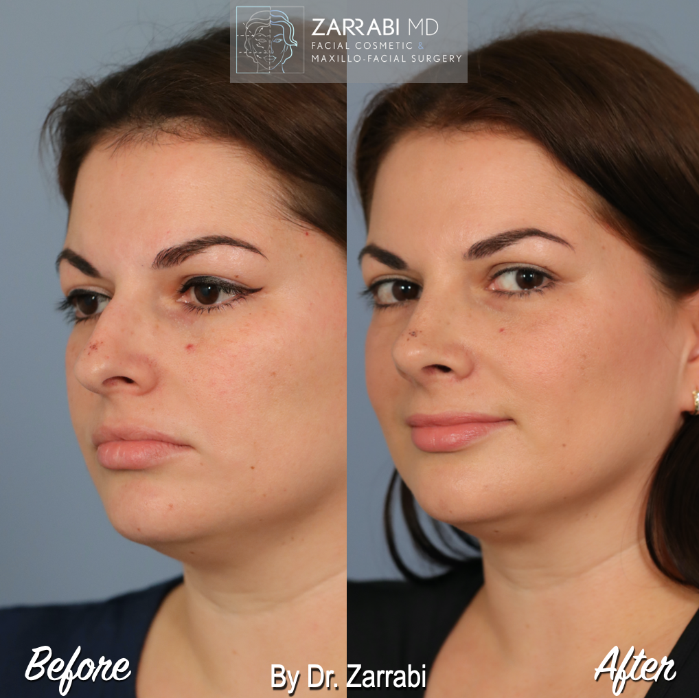 Closed Piezo Rhinoplasty 5 5