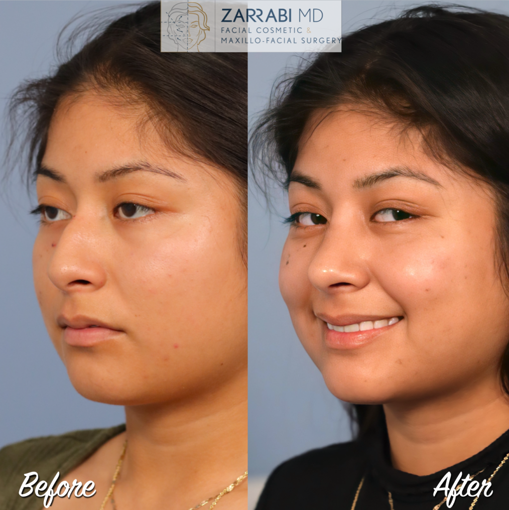 Closed Piezo Rhinoplasty 5 7