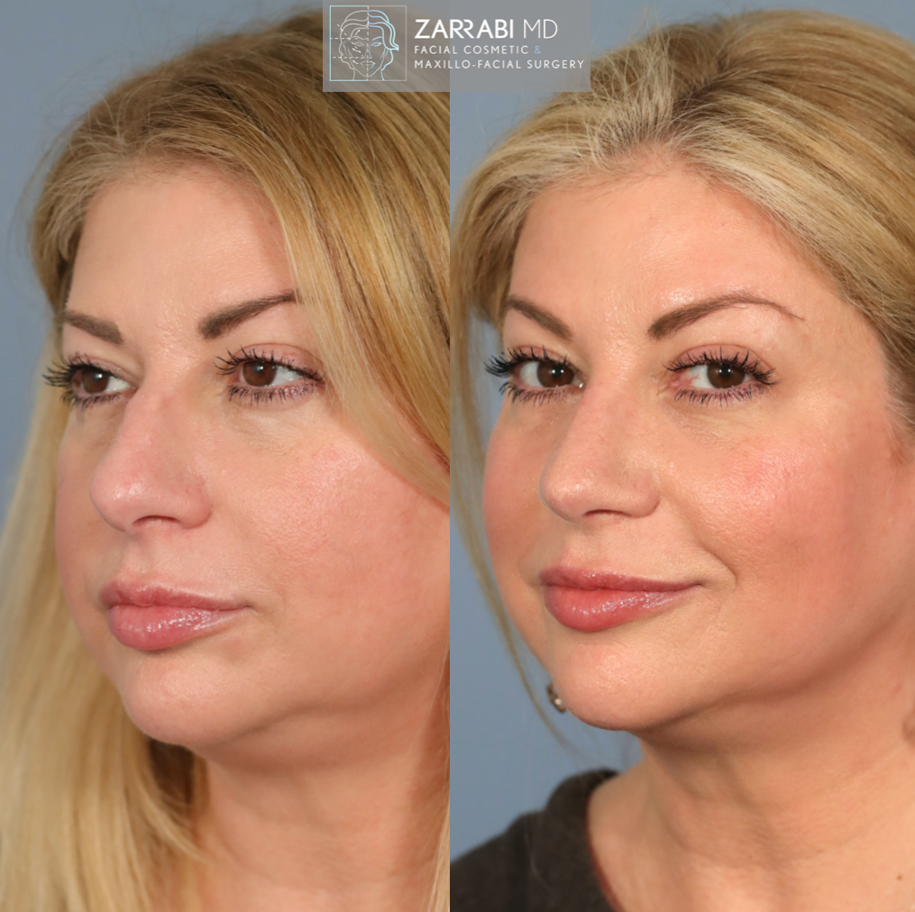 Closed Piezo Rhinoplasty 5