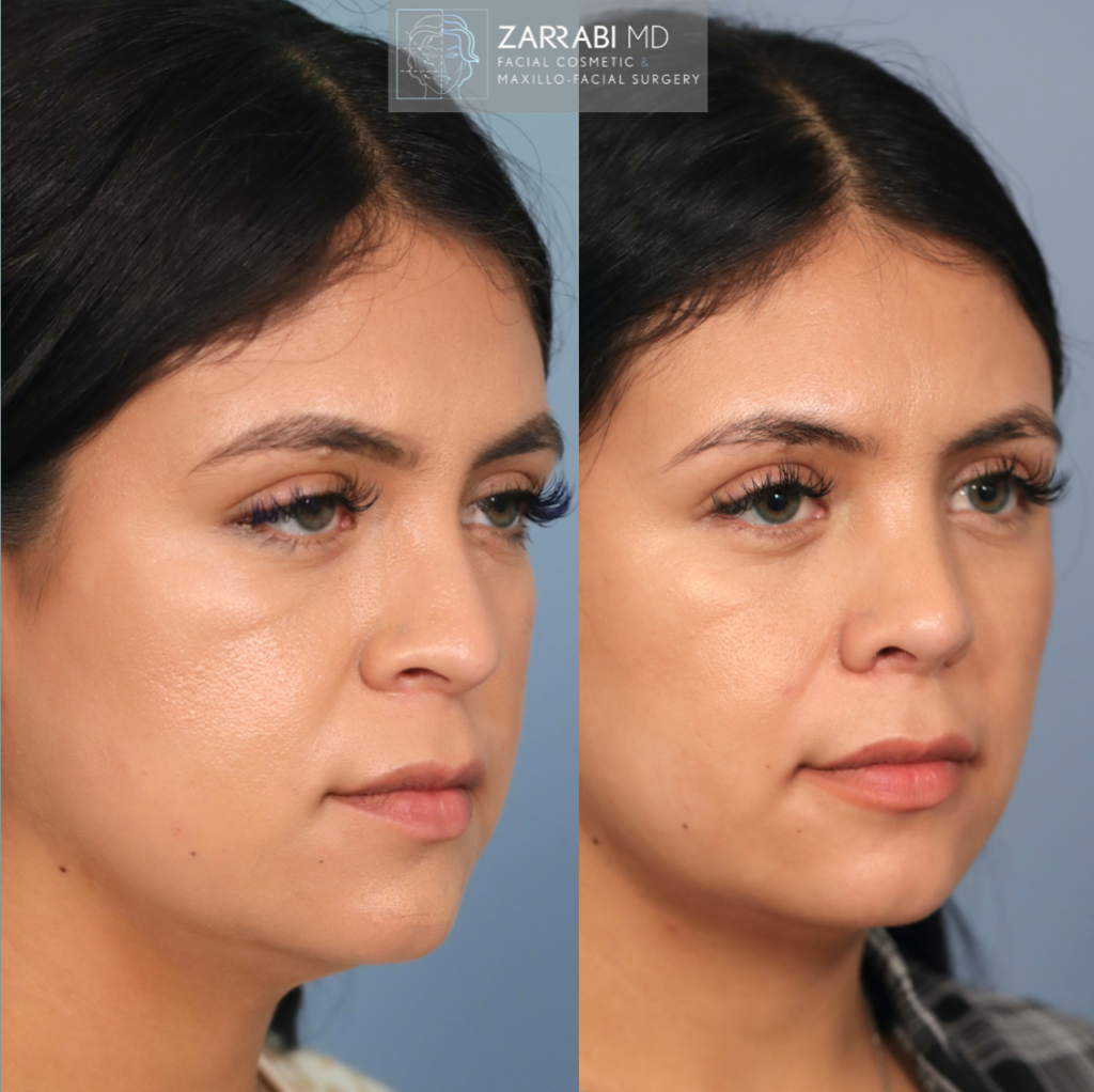 Closed Piezo Rhinoplasty 6 1